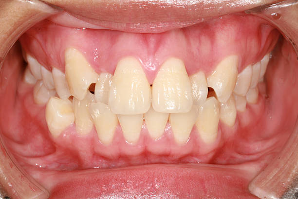 menschlicher zahn - fehlbiss stock-fotos und bilder