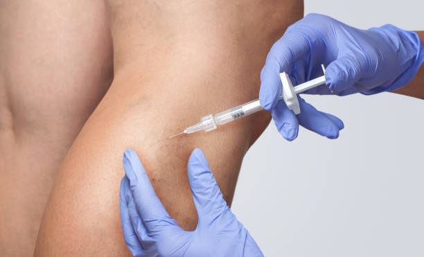 A doctor does medical procedure Sclerotherapy used to eliminate varicose veins and spider veins. An injection of a solution directly into the vein. A doctor does medical procedure Sclerotherapy used to eliminate varicose veins and spider veins. An injection of a solution directly into the vein. human vein stock pictures, royalty-free photos & images