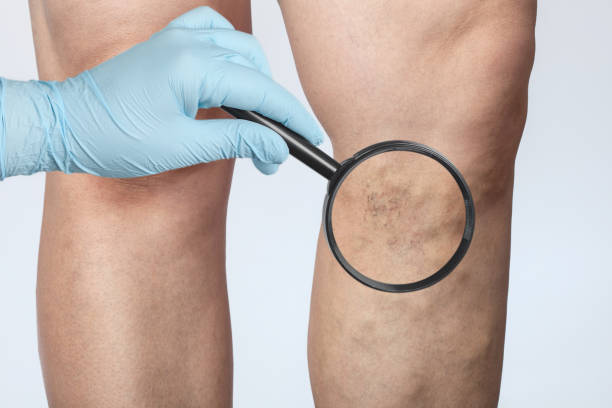 의사는 다리에 피부의 작은 혈관의 팽창을 보여줍니다. 텔라티에시아, 미용학의 건강검진 및 치료 - insufficiency 뉴스 사진 이미지