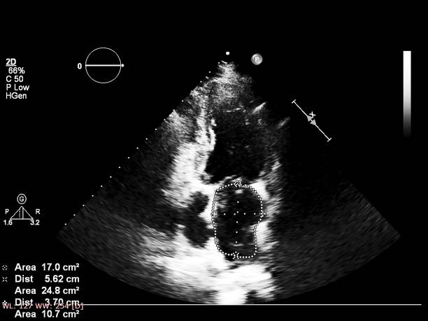 istock Screen of echocardiography (ultrasound) machine. 1184532733