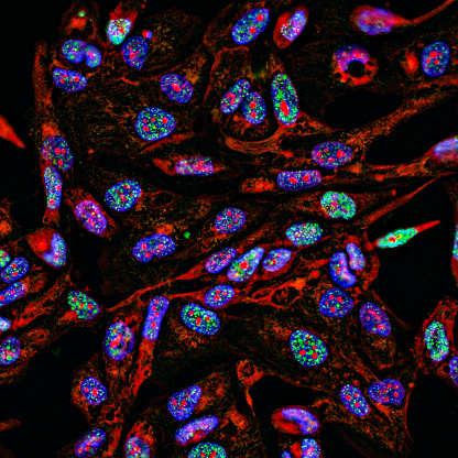 Inmunofluorescencia por imágenes fluorescentes de células cancerosas que crecen en 2D con núcleos en azul, citoplasma en rojo y focos de daño de ADN en verde photo