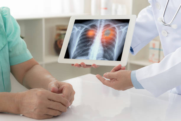 lung cancer medical lung cancer concept. doctor explaining results of lung check up from x-ray scan chest on digital tablet screen to patient. lung photos stock pictures, royalty-free photos & images