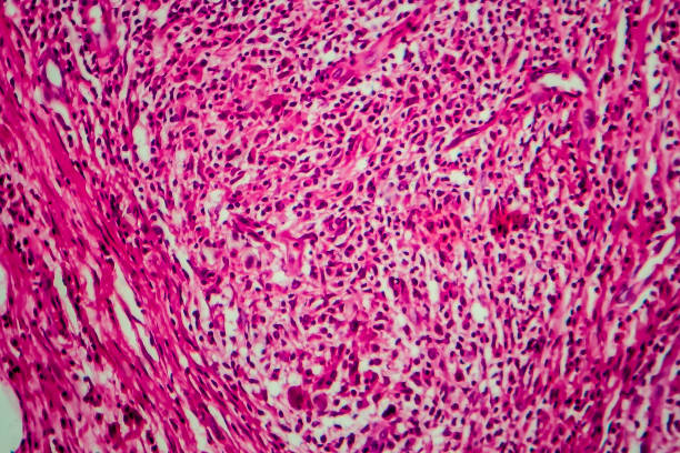 non-hodgkin's lymphoma, light micrograph - non hodgkin lymphoma imagens e fotografias de stock