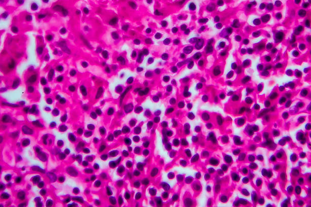 非ホジキンリンパ腫、光顕微鏡写真 - non hodgkin lymphoma ストックフォトと画像