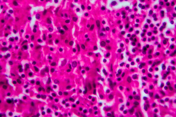 非ホジキンリンパ腫、光顕微鏡写真 - non hodgkin lymphoma ストックフォトと画像