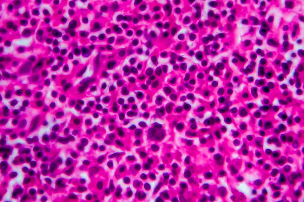 非ホジキンリンパ腫、光顕微鏡写真 - non hodgkin lymphoma ストックフォトと画像