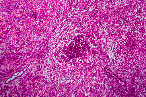 Renal tuberculosis, light micrograph, photo under microscope