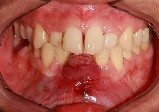 Gingival 炎症性過形成します。 ストックフォト