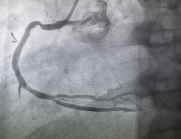 koronare angiographie , rechte koronare angiographie, rechte koronare arterienstenose - human heart heart attack x ray image chest stock-fotos und bilder