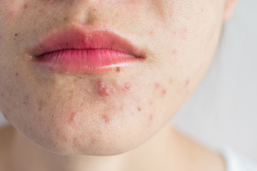 Primer plano de la mitad de la mujer se enfrentan con problemas de inflamación del acné (Papule y Pustule) en su cara. photo