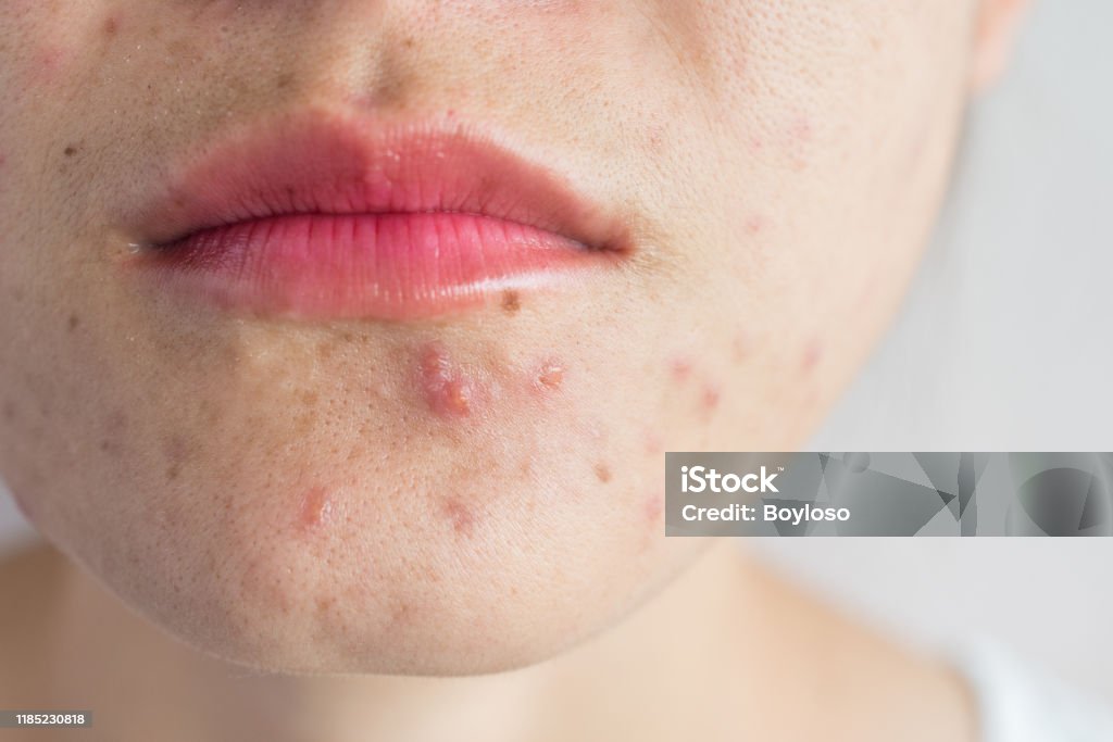 Close-up of woman half face with problems of acne inflammation (Papule and Pustule) on her face. Conceptual of problems on woman skin. Acne Stock Photo