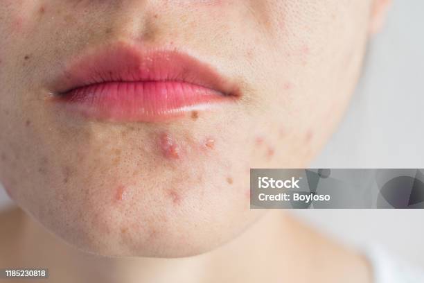 Closeup Of Woman Half Face With Problems Of Acne Inflammation On Her Face Stock Photo - Download Image Now