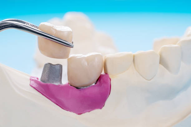 istock Implant Prosthodontics or Prosthetic 1185356074