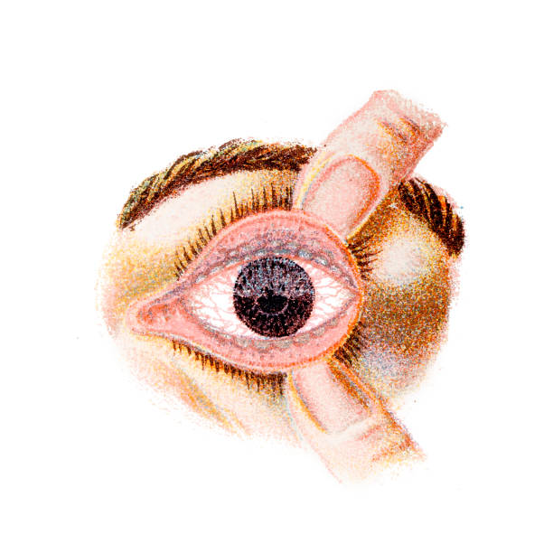 bildbanksillustrationer, clip art samt tecknat material och ikoner med trachoma är en smittsam sjukdom orsakad av bakterien chlamydia trachomatis. infektionen orsakar en grov färgning av den inre ytan av ögonlocken - klamydiatest