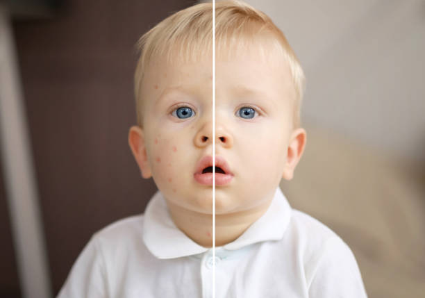 enfant de varicelle, variole, piqûre de moustique, réaction allergique, avant et après rétablissement - chickenpox skin condition baby illness photos et images de collection