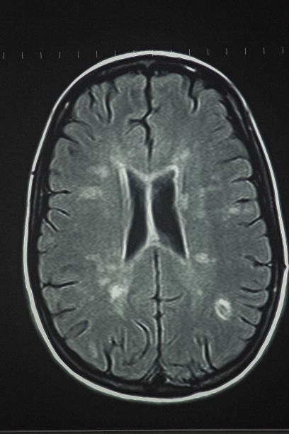 магнитно-резонансная томография рассеянного склероза в головном мозге - brain mri scanner mri scan medical scan стоковые фото и изображения