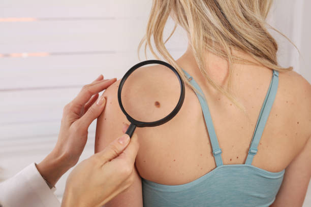 Doctor dermatologist examines birthmark of patient. Checking benign moles. Laser Skin tags removal Doctor dermatologist examines birthmark of patient. Checking benign moles. Laser Skin tags removal skin exame stock pictures, royalty-free photos & images
