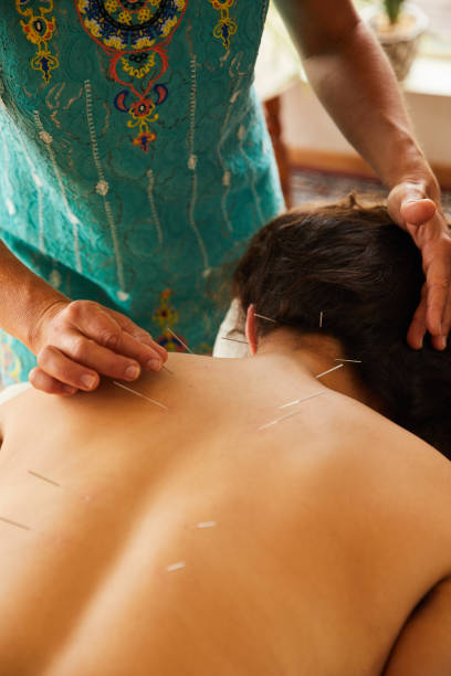 istock Acupuncturist treating a client's back with needles in her clinic 1185865833