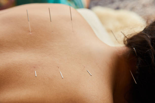 istock Woman having acupuncture on her back on a clinic table 1185869044