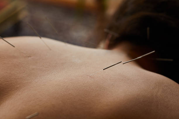 istock Woman getting acupuncture done on her back in a clinic 1185869509