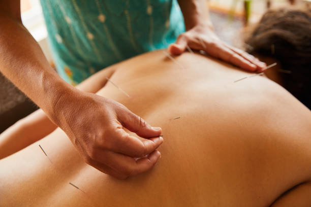 alternativer therapeut vorformiert akupunktur auf dem rücken einer patientin - alternative medicine massaging spa treatment back stock-fotos und bilder