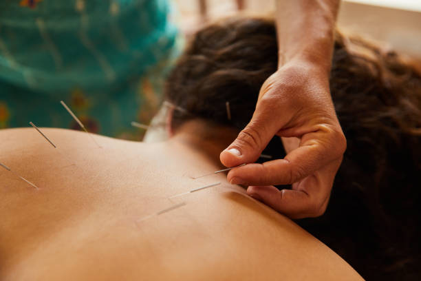 istock Woman having an acupunture treatment on her back 1185873036