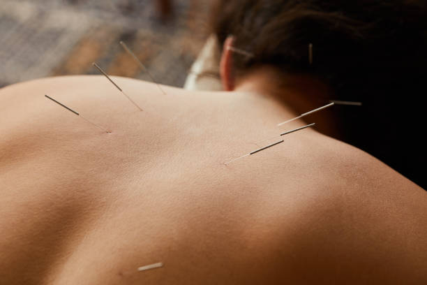 istock Woman having acupuncture done on her back in a clinic 1185874542