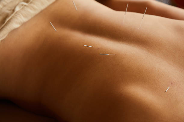 istock Woman on a table getting acupuncture done to her back 1185884822