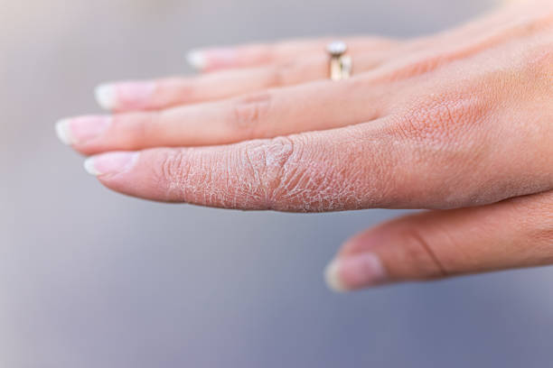 ジシドロ性ポンプホリックまたは小胞性ジドロシスと呼ばれる湿疹病状を示す女性若い女性の手の人差し指の乾燥したひび割れ皮膚マクロのクローズアップ - dry ストックフォトと画像