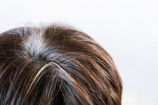Back view of young people premature gray hair, showing black hoary hair roots on head change to senior old man