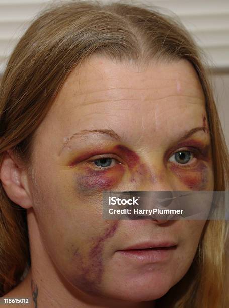 Face Of Abuse Stock Photo - Download Image Now - Sexual Assault, Victim, Wife