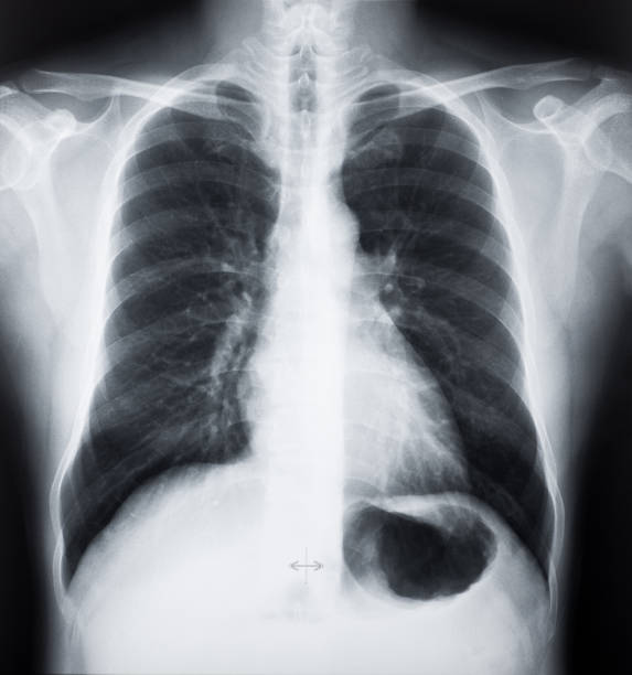 immagini a raggi x del torace o del polmone umano - human lung asthmatic x ray human internal organ foto e immagini stock