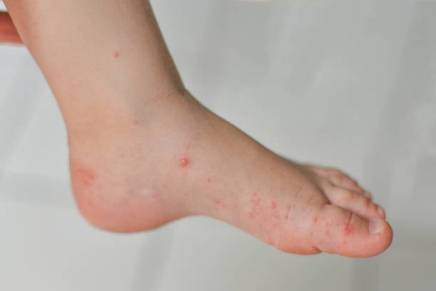 Enterovirus Leg arm mouth Rash on the body of a child Cocksackie virus Enterovirus Legs hands mouth Rash on the body of a child Cocksackie virus hand foot and mouth disease stock pictures, royalty-free photos & images