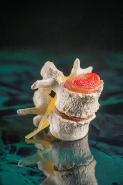 istock Vertebrae and discs. Neurodegenerative disease. 1186422283