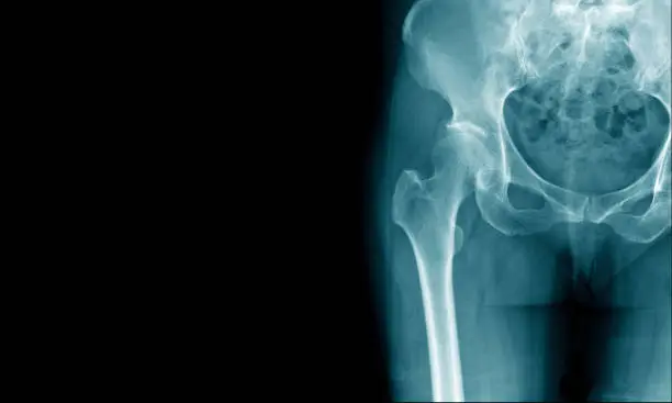 Photo of x-ray image of hip and show degenerative change