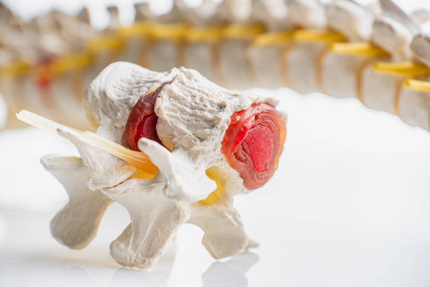 istock Vertebrae and discs. Neurodegenerative disease. 1186501128