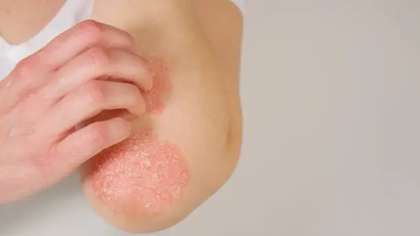 Photo of CLOSE UP Woman suffering from psoriasis skin disease scratching scaly elbows