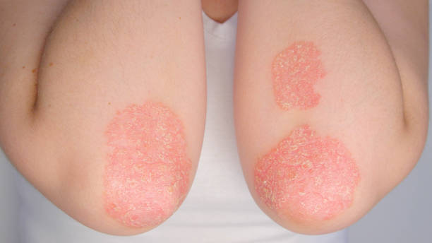 CLOSE UP: Painful patches of irritated skin cracking on unknown patient's elbows CLOSE UP Painful patches of irritated skin cracking on unknown psoriasis patient's elbows. Pesky and painful rashes with flaking skin growing larger on Caucasian person's arms. Unpleasant skin disease scab arm stock pictures, royalty-free photos & images