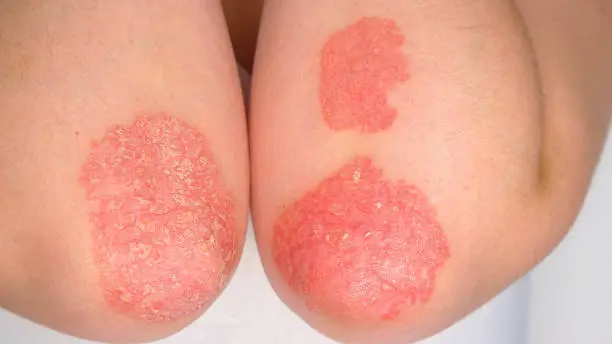 Photo of CLOSE UP: Psoriasis symptoms - red scaly patches, flaky skin tissue on elbows