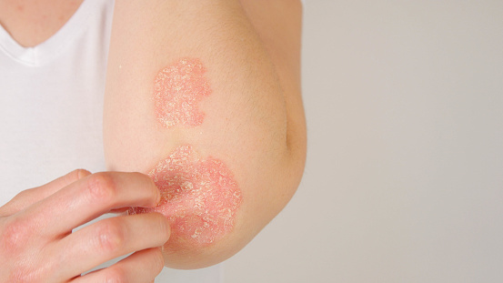 CERCA: Paciente femenina irreconocible que sufre de enfermedad de la piel de la psoriasis photo
