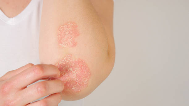 CLOSE UP: Unrecognizable female patient suffering from psoriasis skin disease CLOSE UP: Unrecognizable young woman suffering from autoimmune incurable dermatological skin disease called psoriasis. Female gently scratching red, inflamed, scaly rash on elbows. Psoriatic arthritis skin inflammation stock pictures, royalty-free photos & images