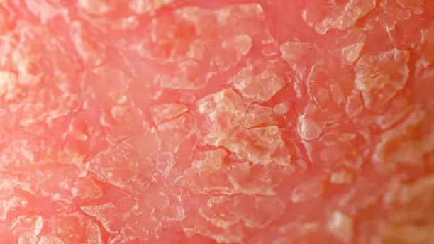 Photo of CLOSE UP, MACRO: Patches of abnormal skin, psoriasis, inflammation, eczema, rash