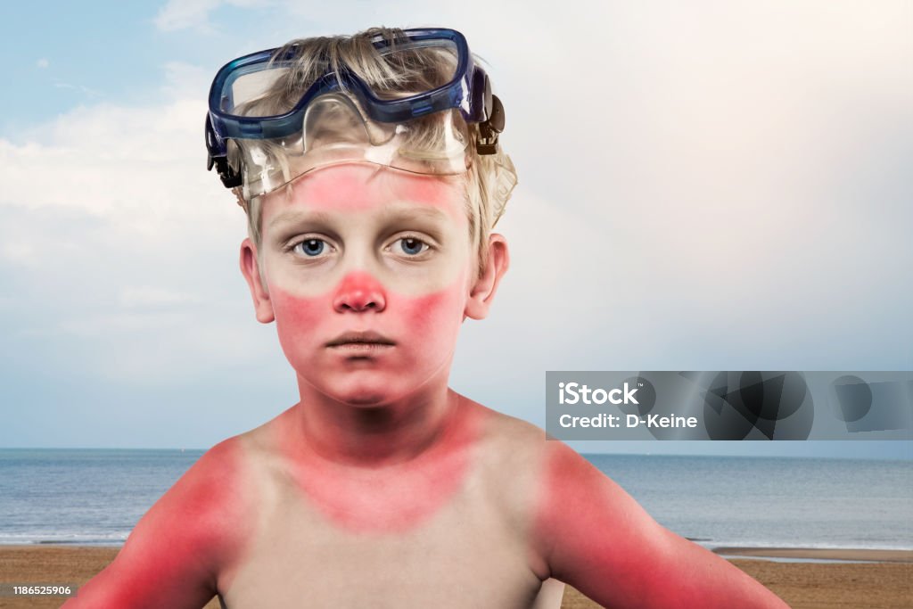 Sunburned boy Sunburned boy wearing scuba mask standing in front of the sea Sunburned Stock Photo