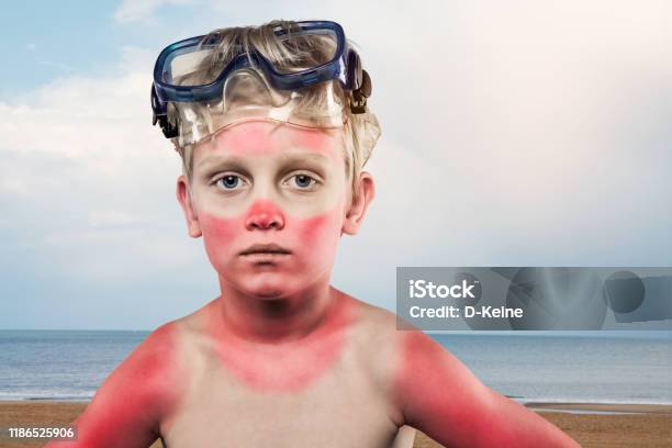 Sunburned Boy Stock Photo - Download Image Now - Sunburned, Child, Sun
