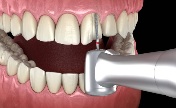 central incisor vorbereitungsprozess für die zahnärztliche veneer platzierung. medizinisch genaue 3d-illustration - handpiece stock-fotos und bilder