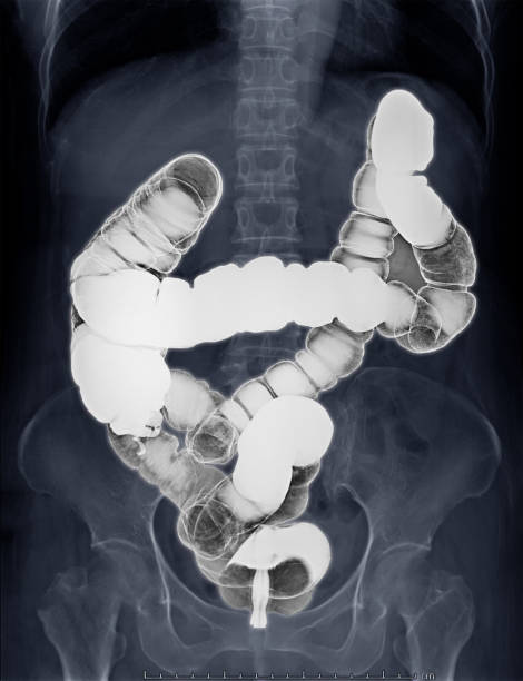 barium-einlaufbild oder röntgenbild des dickdarms - barium stock-fotos und bilder