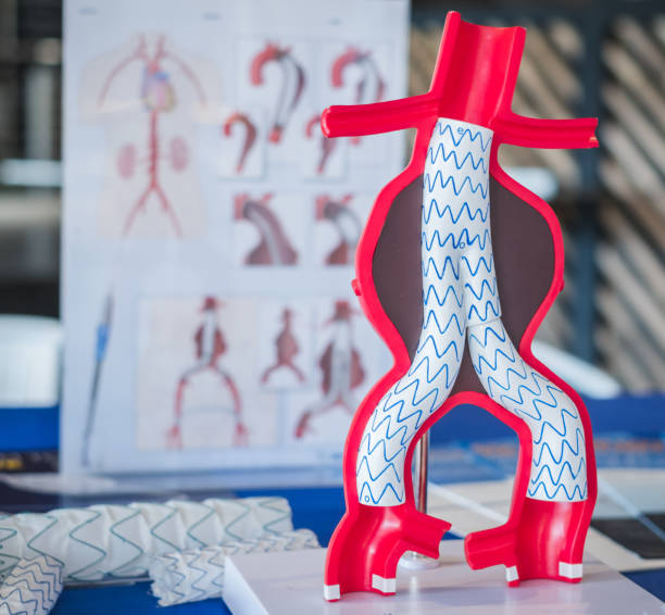 model of endovascular aneurysm repair (evar) for people education. model of endovascular aneurysm repair (evar) for people education. anatomist photos stock pictures, royalty-free photos & images