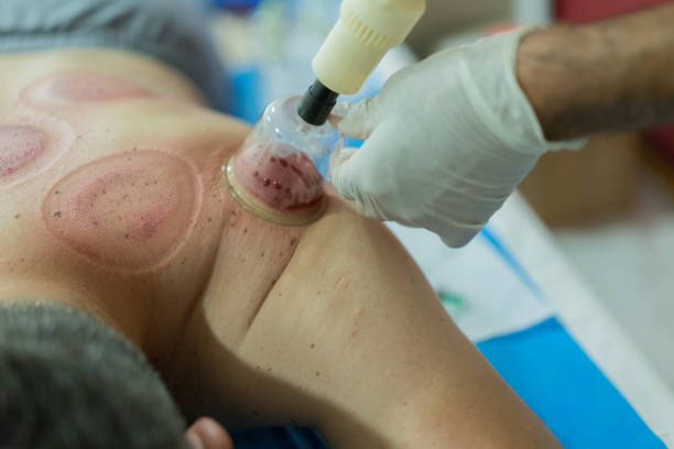 istock Acupuncturist performs massage cupping therapy hacamat 1186928376