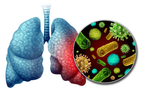 istock Pneumonia Infection Anatomy 1186950894
