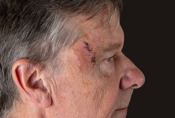 상처에 피부암 바늘을 제거하는 mohs 수술 후 노인의 측면보기 - 기저세포암종 뉴스 사진 이미지
